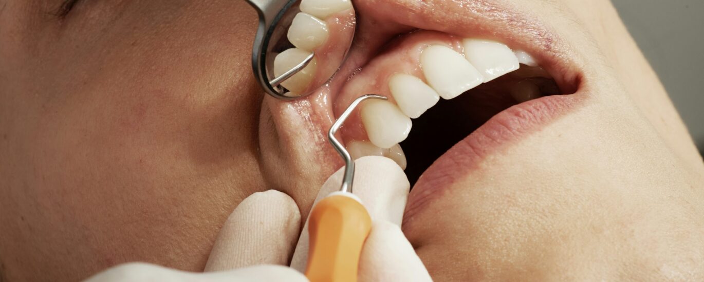 Patient receiving a hygienist scale and polish treatment