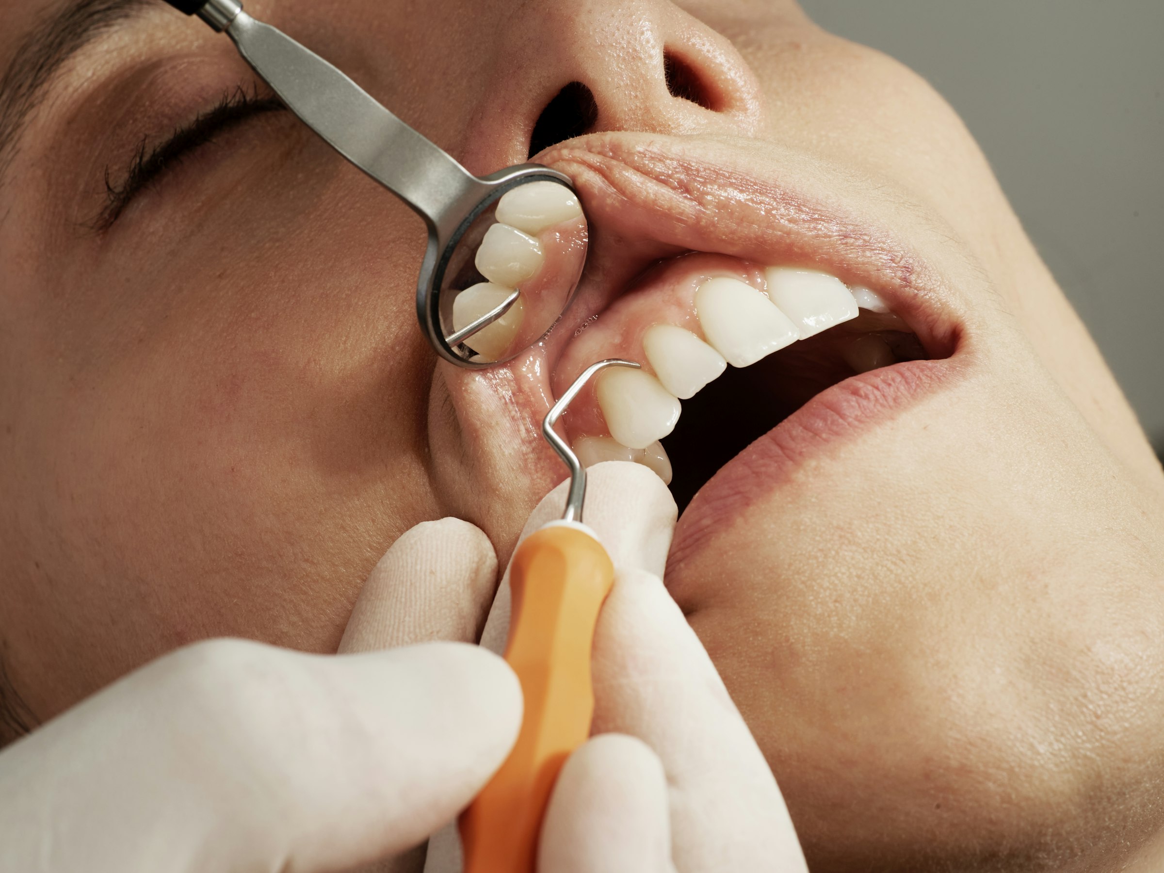 A patient receiving a gentle hygienist scale and polish